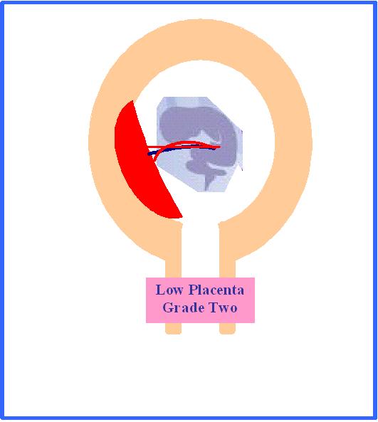 Placenta Praevia Grade Two Dr Youssif